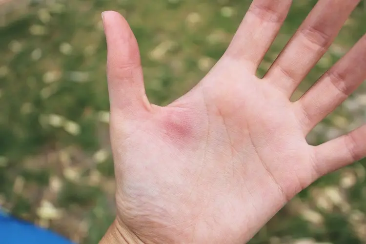 A large lump on a woman's hand from a Bull Ant sting in Australia.
